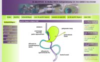 gastric bypass met fobi ring