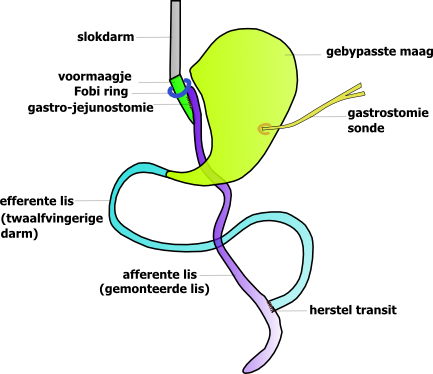 gastric bypass volgens fobi